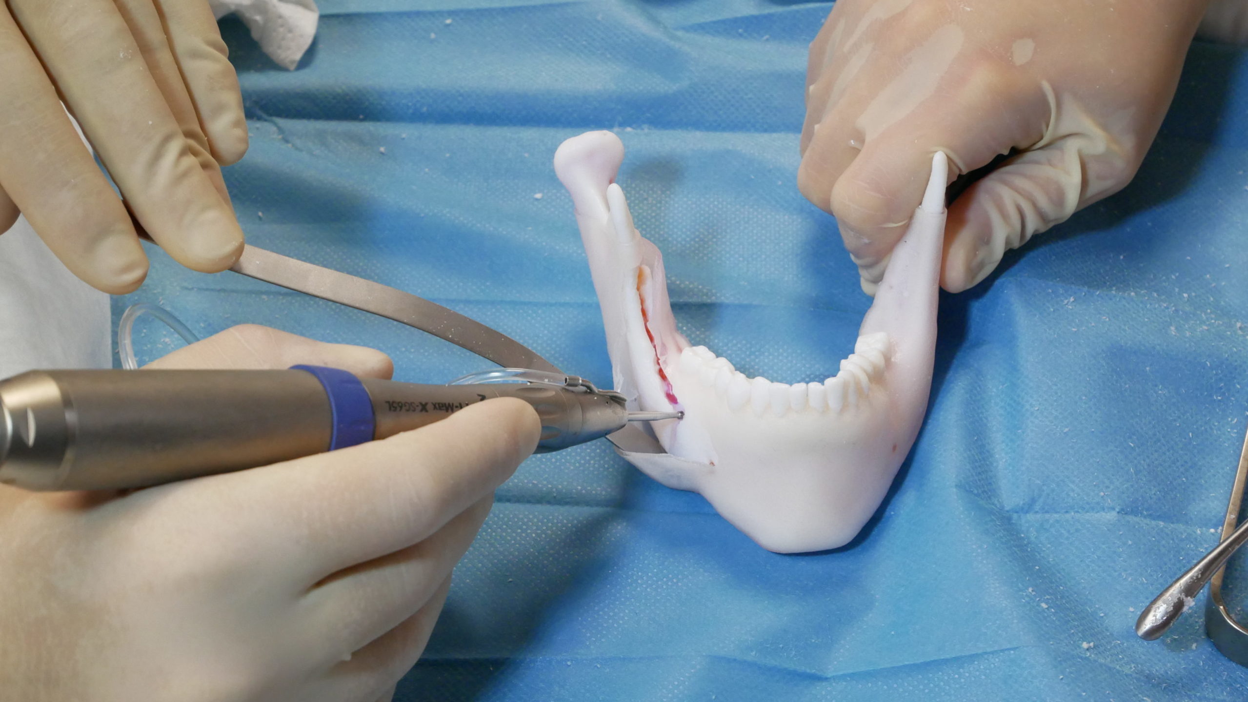 Ostéotomie sur modèle imprimé en 3D