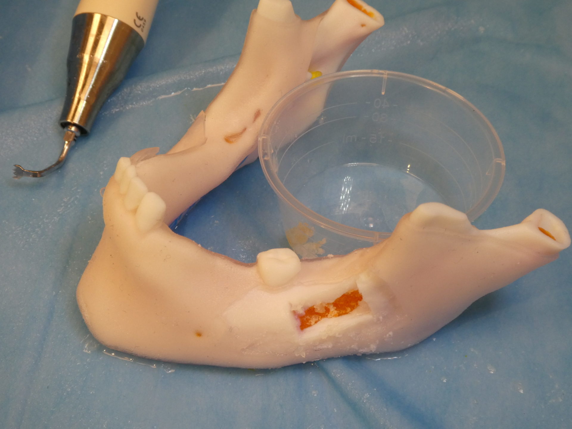 Prélèvement ramique sur modèle de chirurgie maxillo-faciale imprimé en 3D