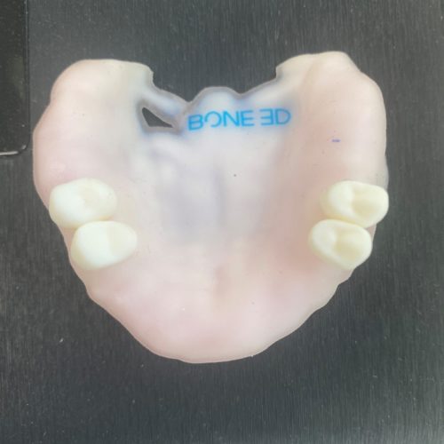 Modèle d'implantologie à 6 sites (vue à plat) imprimé en 3D