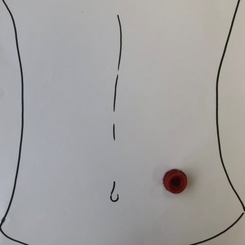 Modèle de stomie imprimé en 3D posé sur schéma ventre 