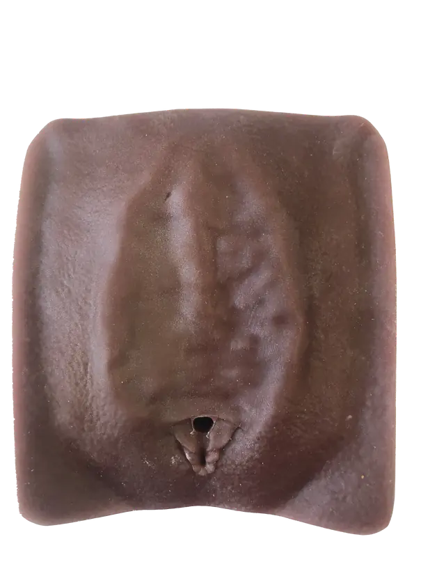 Modèle anatomique · excision de type 3